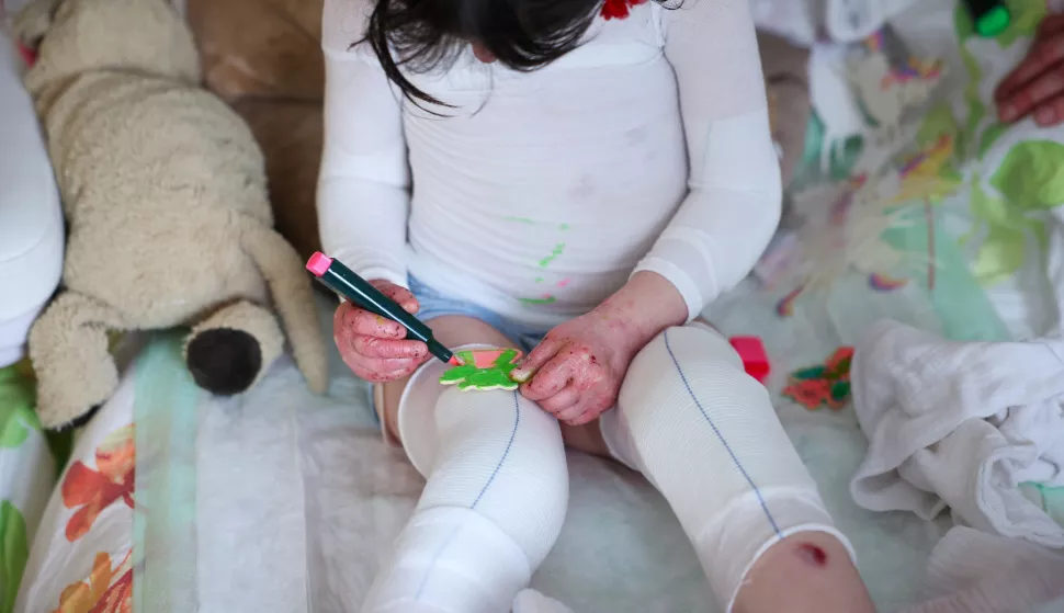 03 April 2024, Saxony, Zwickau: K?the, who suffers from the very rare butterfly disease, undergoes daily, two-hour dressing changes. The four-year-old suffers from incurable epidermolysis bullosa (EB) - a genetic defect causes the cohesion of the skin layers to be weakened. The result: even the smallest injuries, friction or pressure lead to blisters and open wounds. A new treatment method from the USA offers hope. A gel is used to supply the skin with new collagen7A1 genes. The sticking point: the price of around 800,000 US dollars (around 737,000 euros) for a six-month treatment. Photo: Jan Woitas/dpa Photo: Jan Woitas/DPA