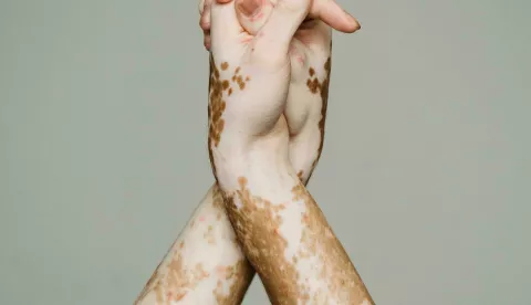BOLEST VITILIGO
