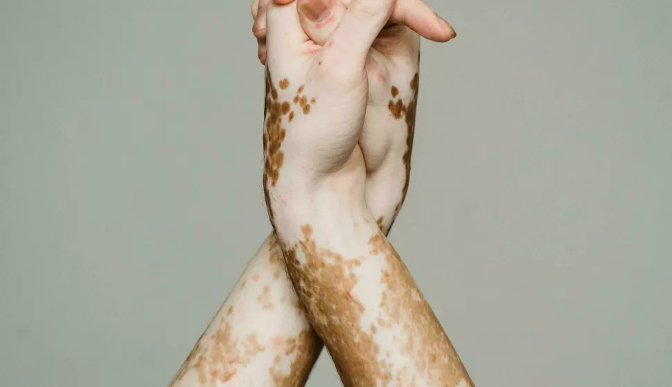 BOLEST VITILIGO