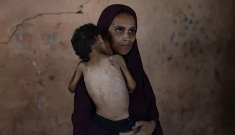 epa12247632 Palestinian child Yazan Abu Foul, aged two, is cared for by his mother Naima, as he suffers from severe malnutrition due to the acute shortage of food caused by the blockade imposed on the Gaza Strip and the closure of border crossings, in Al-Shati refugee camp, west of Gaza City, 19 July 2025. Yazan lives in harsh environmental and health conditions, with his family lacking the basic necessities of life amid a worsening humanitarian crisis. According to medical sources, the child's health continues to deteriorate due to the lack of proper nutrition and necessary medical care. Humanitarian organizations have warned of an imminent food catastrophe threatening the lives of thousands of children in the besieged Gaza Strip, this situation coming at a time when Gaza's residents face severe food insecurity and a sharp decline in health services, amid ongoing restrictions on the entry of humanitarian aid and essential supplies. EPA/HAITHAM IMAD