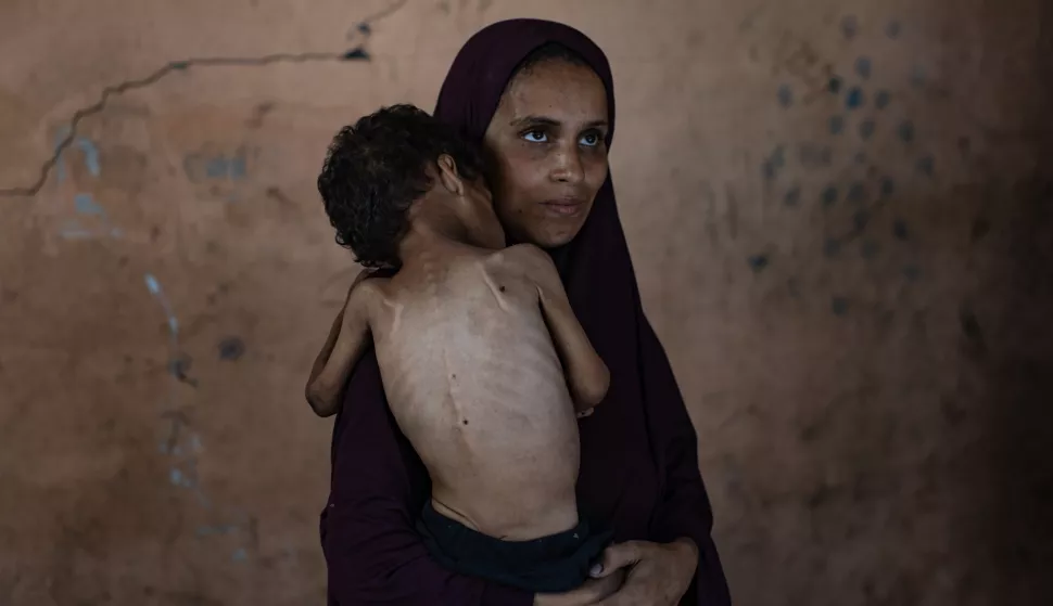 epa12247632 Palestinian child Yazan Abu Foul, aged two, is cared for by his mother Naima, as he suffers from severe malnutrition due to the acute shortage of food caused by the blockade imposed on the Gaza Strip and the closure of border crossings, in Al-Shati refugee camp, west of Gaza City, 19 July 2025. Yazan lives in harsh environmental and health conditions, with his family lacking the basic necessities of life amid a worsening humanitarian crisis. According to medical sources, the child's health continues to deteriorate due to the lack of proper nutrition and necessary medical care. Humanitarian organizations have warned of an imminent food catastrophe threatening the lives of thousands of children in the besieged Gaza Strip, this situation coming at a time when Gaza's residents face severe food insecurity and a sharp decline in health services, amid ongoing restrictions on the entry of humanitarian aid and essential supplies. EPA/HAITHAM IMAD