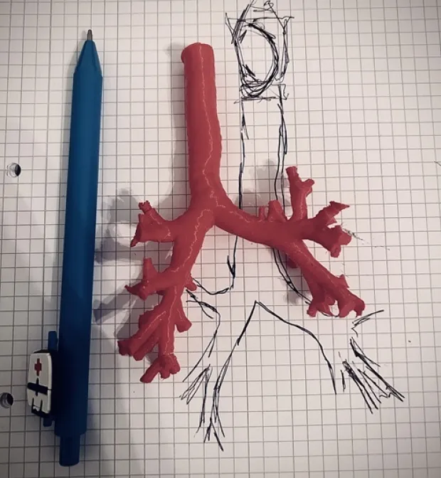 Bronhoskopska resekcija tumorske tvorbe dušnika novorođenčeta