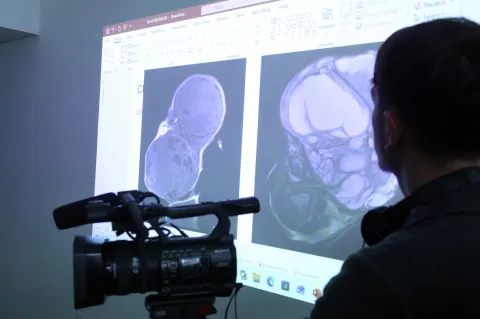 Zagreb, 24.11.2025 - Konferencija za novinare na KBC-u Zagreb u povodu uspješnog izvođenja novog, medicinski zahtjevnog zahvata visoke složenosti na malom pacijentu s izrazito velikim tumorom vrata, a koji je operativno zbrinut neposredno nakon rođenja.foto HINA/ Denis CERIĆ /dc