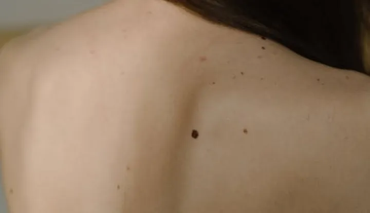 Besplatni pregledi madeža uz prijave u Na&scaron;icama, Valpovu i Osijeku