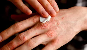 Psorijaza - edukacije za oboljele 
